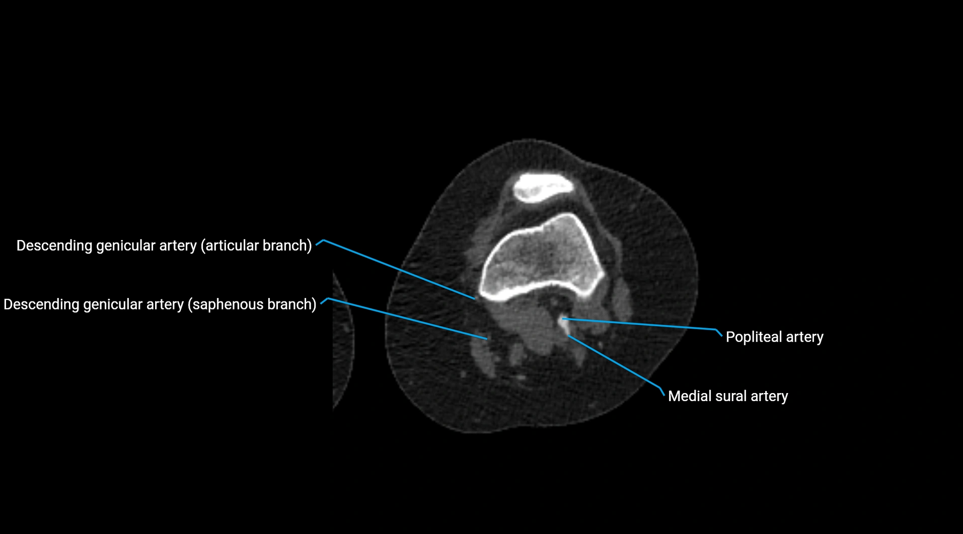 CTA lower limb cross sectional anatomy labelled image _168.webp